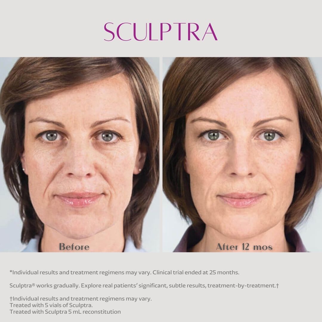 harshtag  #Sculptra #Sculptraคือ  #Sculptraคืออะไร   #Sculptra ดีอย่างไร   #Sculptra ที่ไหนดี #Sculptra ราคา #Sculptra รีวิว #Sculptra ช่วยอะไร #Sculptra ดีไหม #Sculptra อ่านว่า