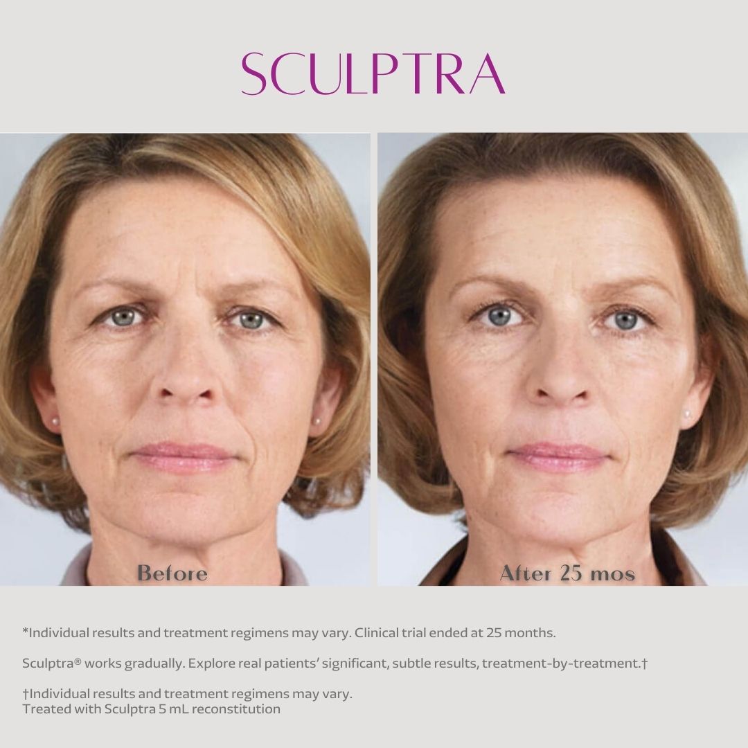 harshtag  #Sculptra #Sculptraคือ  #Sculptraคืออะไร   #Sculptra ดีอย่างไร   #Sculptra ที่ไหนดี #Sculptra ราคา #Sculptra รีวิว #Sculptra ช่วยอะไร #Sculptra ดีไหม #Sculptra อ่านว่า