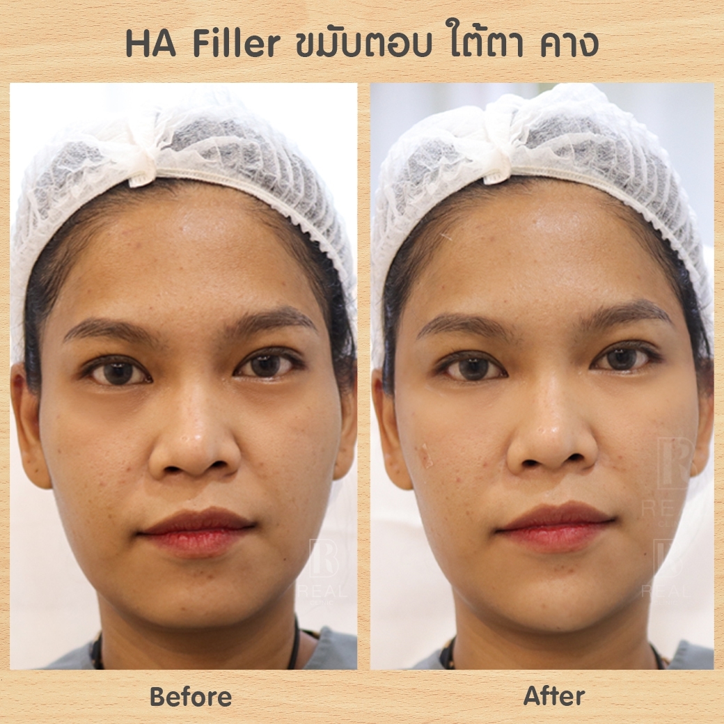 ฟิลเลอร์ใต้ตา ฉีดฟิลเลอร์ใต้ตา ฟิลเลอร์ใต้ตา ฉีดฟิลเลอร์ใต้ตา