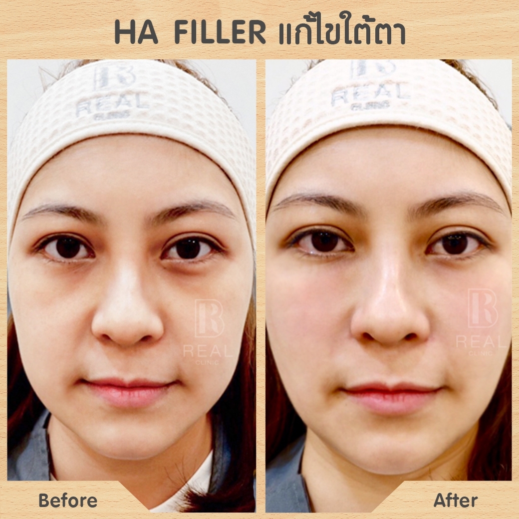 ฟิลเลอร์ใต้ตา