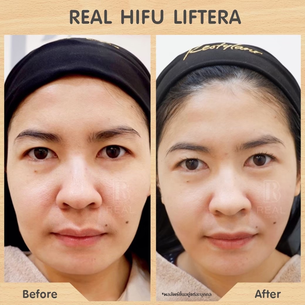 รีวิว hifu