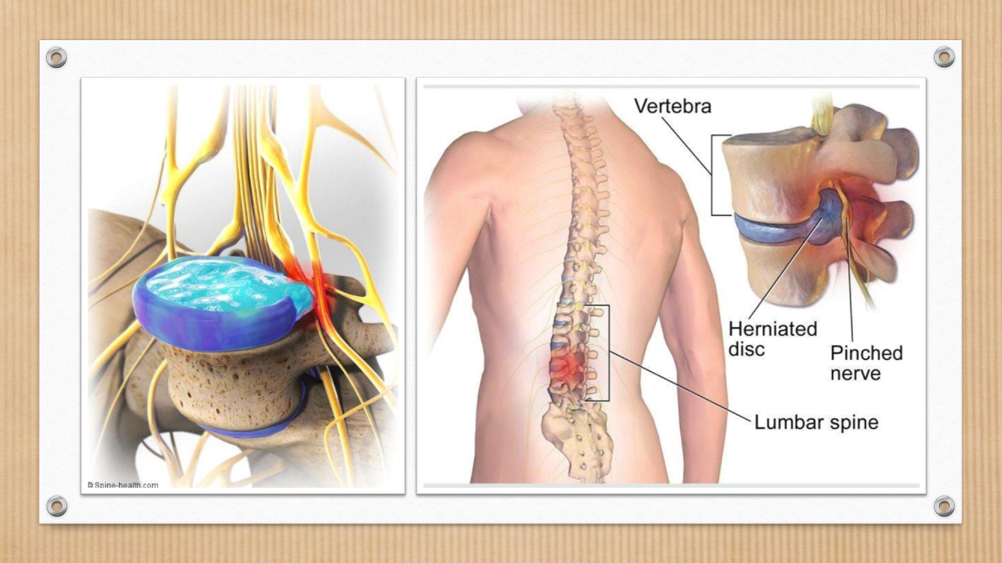 Part 2 : โรคหมอนรองกระดูกทับเส้นประสาท (Herniated Disc) - Huachiewtcm