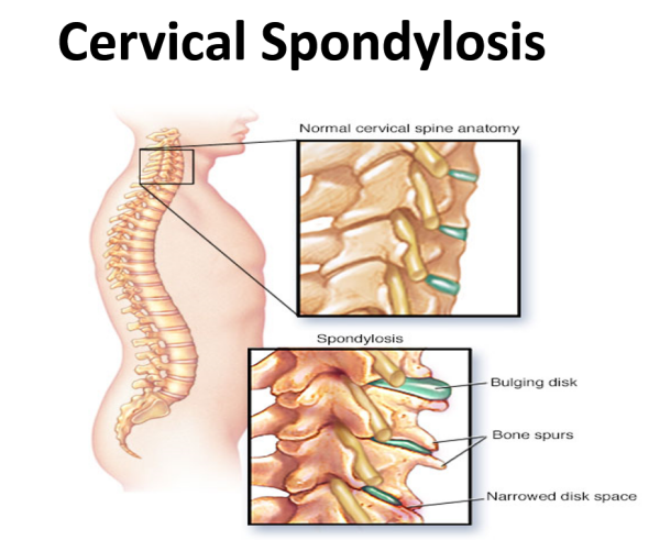 โรคกระด กคอเส อม Cervical Spondylosis Huachiewtcm