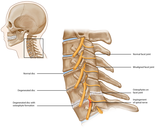 โรคกระด กคอเส อม Cervical Spondylosis Huachiewtcm