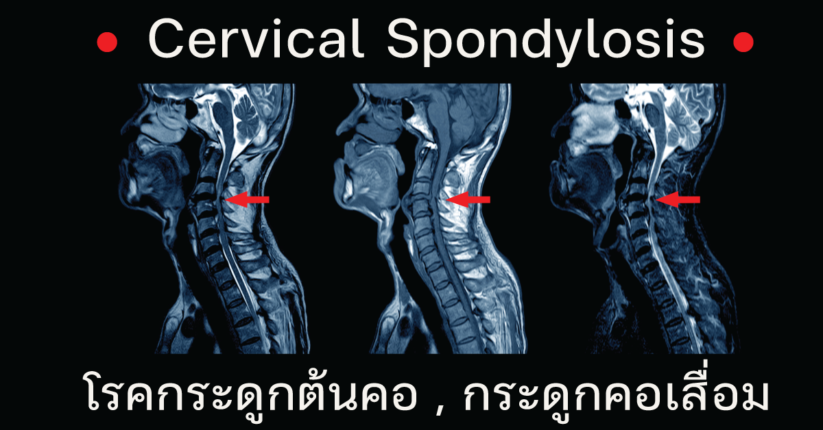 โรคกระดูกต้นคอ กระดูกคอเสื่อม Cervical Spondylosis