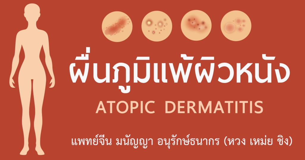 atopic dermatitis อาการ treatments