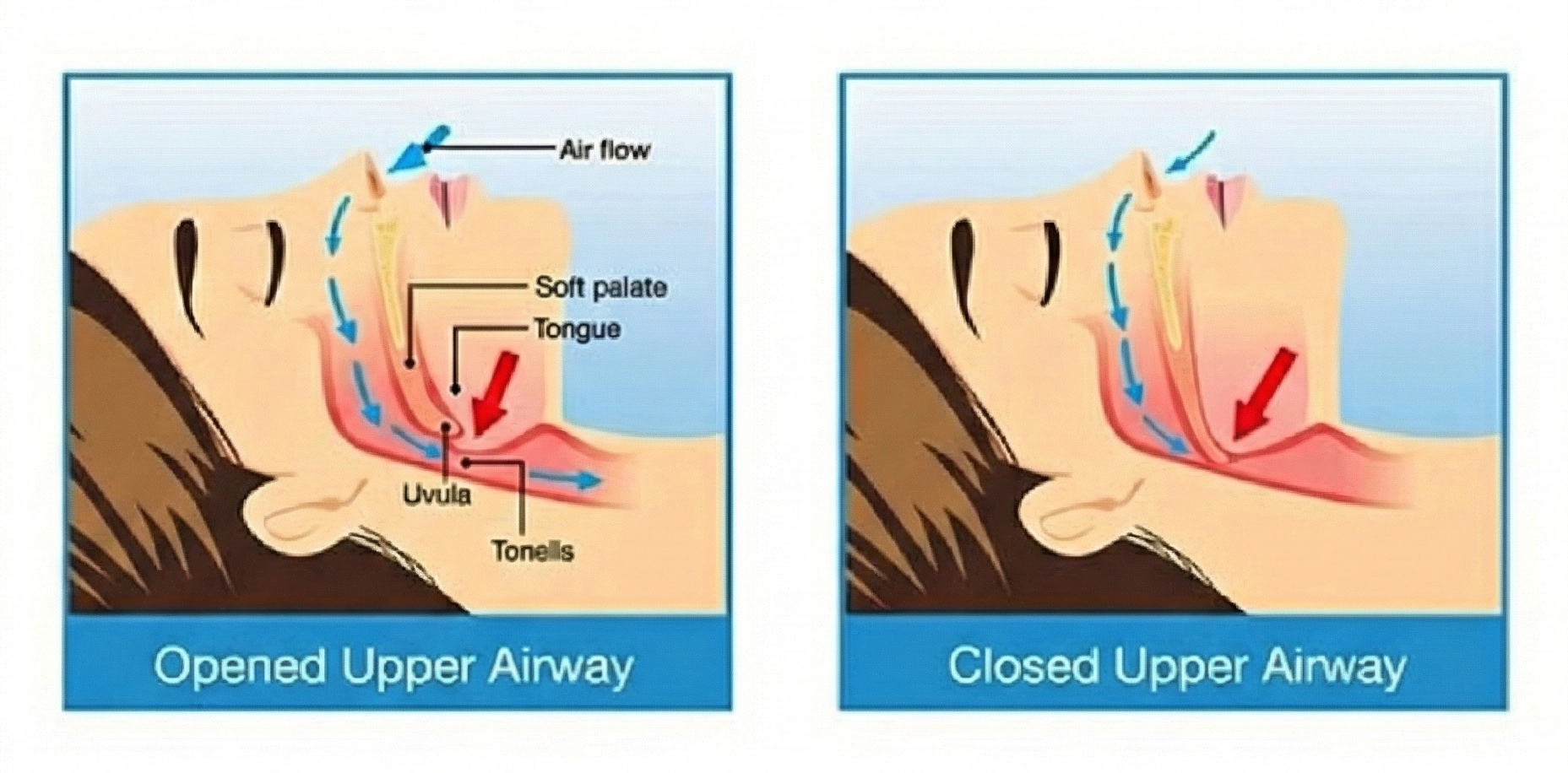ภาวะหยุดหายใจขณะหลับ