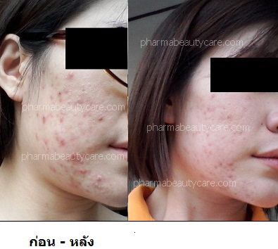 โดยเภสัชกร เจลรักษาสิวอักเสบ สิวสเตอรอยด์ ผสมสารสกัดจากเปลือก  