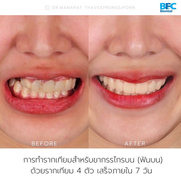 BFC เคสฝังรากเทียมทั้งปากสำหรับขากรรไกรบน (ฟันบน) ด้วยระบบ Digital พร้อมมีฟันภายใน 7 วัน 