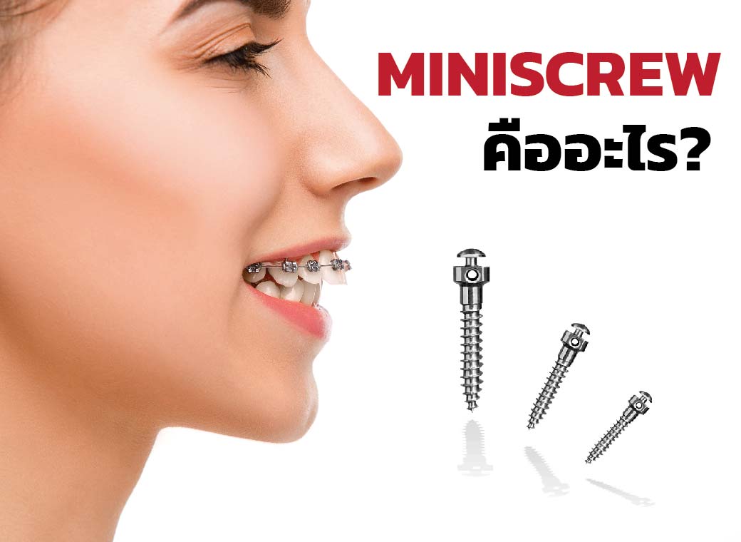 หมุดจัดฟัน (Mini-Screws) คืออะไร มีประโยชน์อย่างไรนะ?