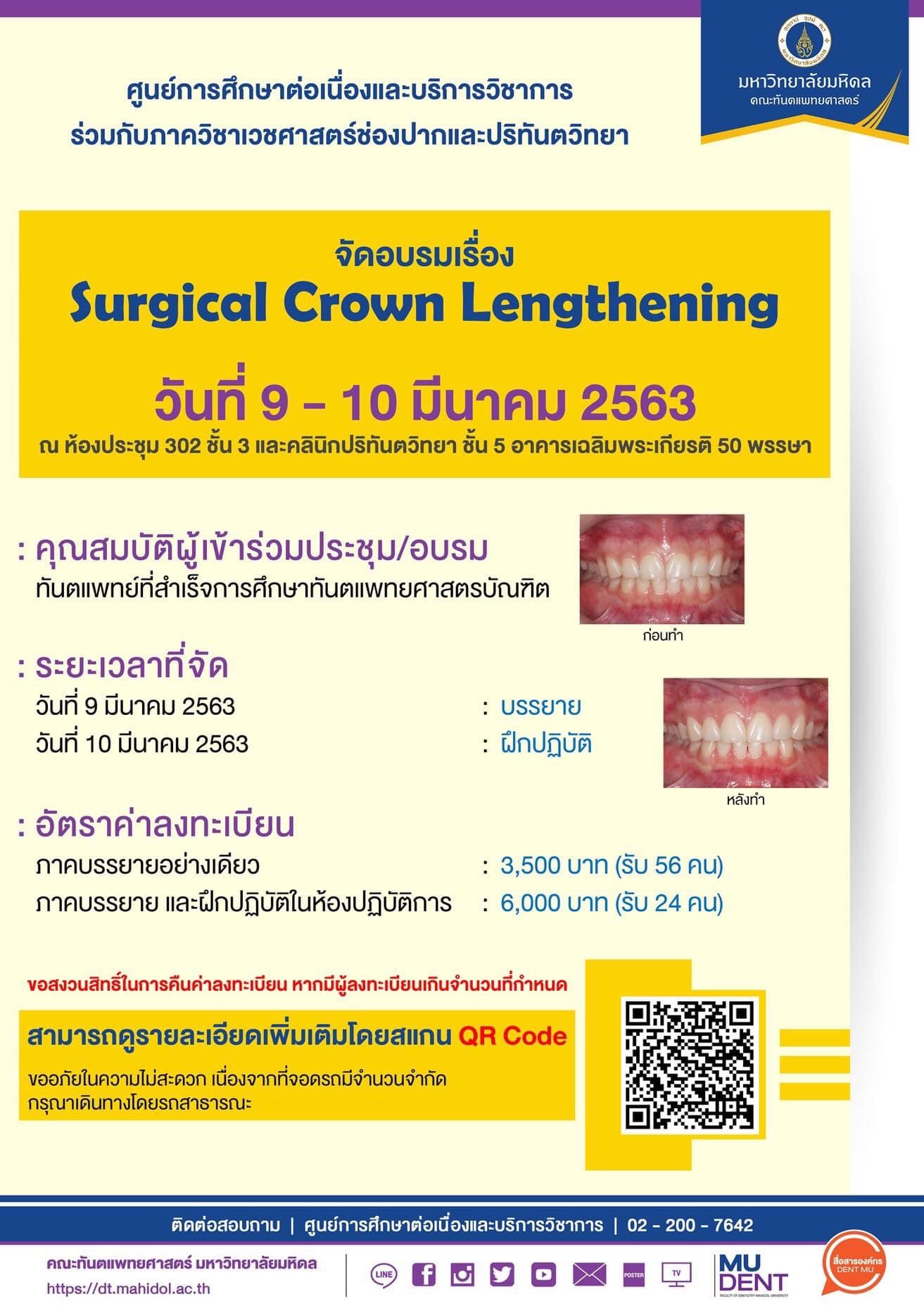 Surgical Crown Lengthening