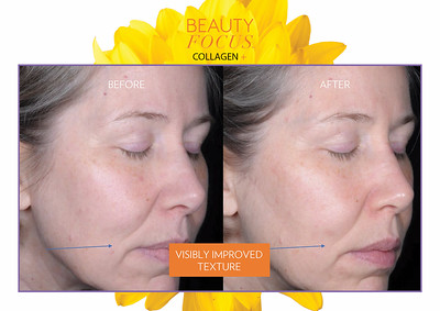 <Img src =”beauty focus collagen+.jpg” alt=“beauty focus collagen+ results 2”>