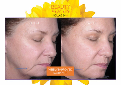 <Img src =”beauty focus collagen+.jpg” alt=“beauty focus collagen+ before & after 1”>