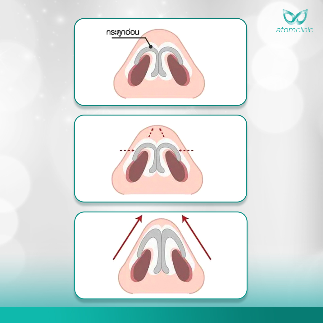 เสริมจมูก