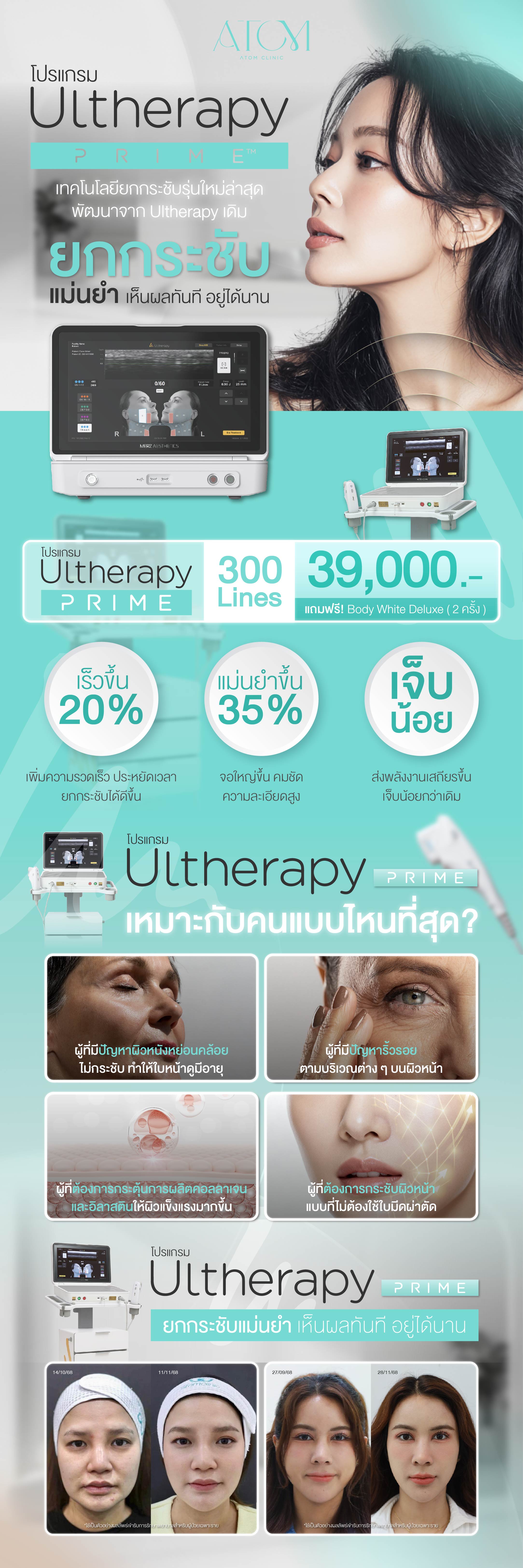 โปรโมชั่น Ulthera prime