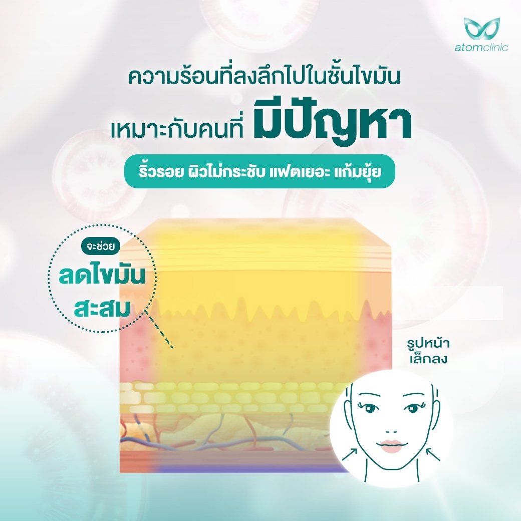 Thermage FLX Atomclinic Thermage FLX Atomclinic