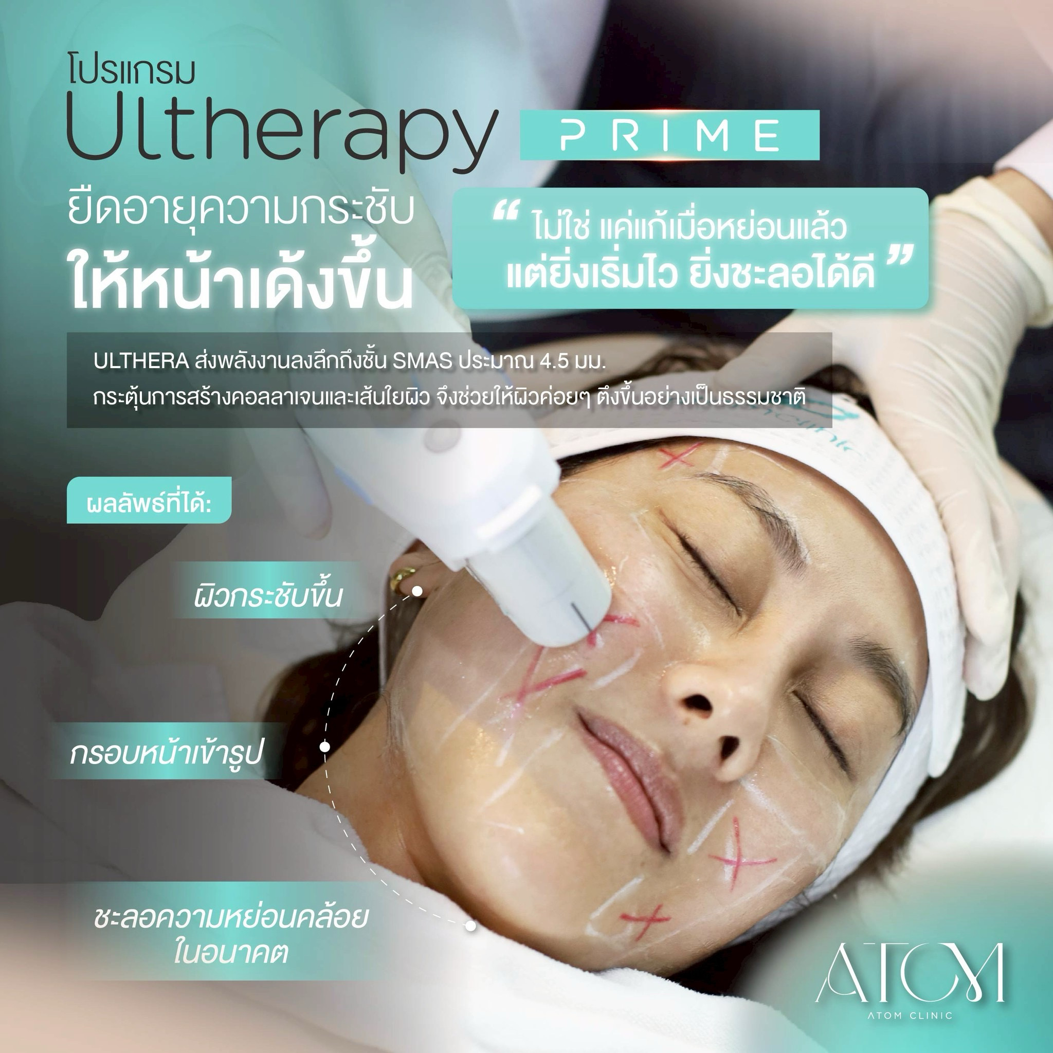 Ultherapy PRIME ช่วยอะไรบ้าง?