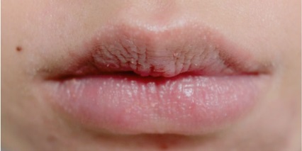 ลดอาการปากเเห้งปากอักเสบจากเเสงเเดด ช่วยให้ริมฝีปากชุ่มชื้นมีสารสกัดจากชาเขียวช่วยป้องกันริมฝีปากจากเเสงเเดด