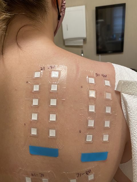 การตรวจหาภูมิเเพ้ Patch Test ผิวเเพ้ง่าย การตรวจหาภูมิเเพ้ Patch Test สำหรับคนที่หาสาเหตุการเเพ้ไม่ได้