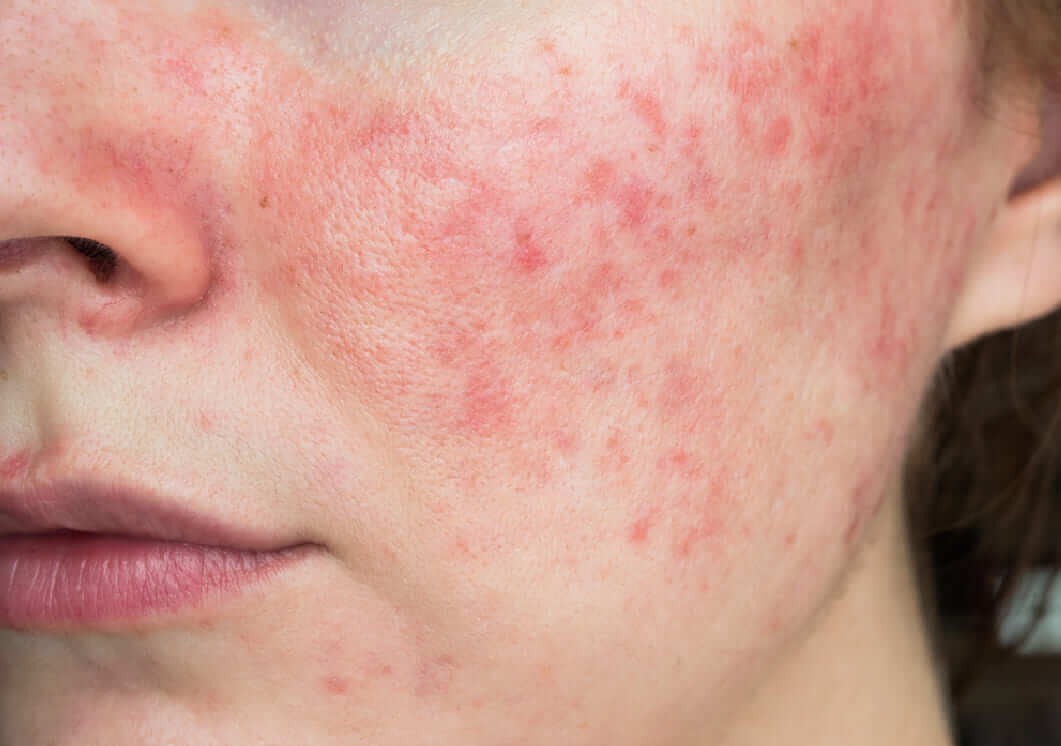 ใบหน้าที่มีอาการผิวเเพ้ง่าย หากมีอาการผิวเเพ้ง่ายหน้าจะมีผื่นเเดงเเบบนี้