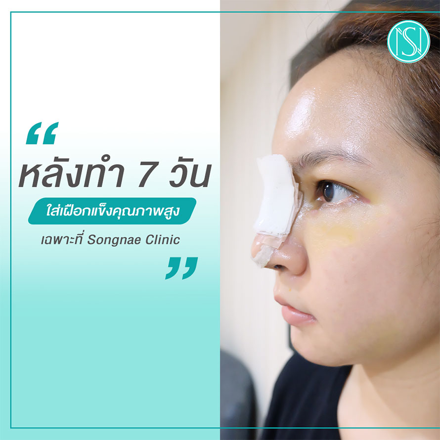 รีวิวเสริมจมูกCLL ผู้หญิง รีวิวเสริมจมูกCLL ผู้หญิง