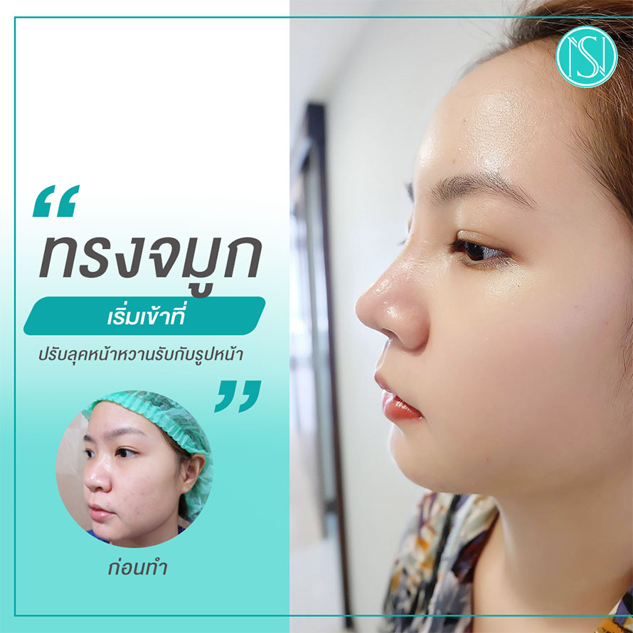 รีวิวเสริมจมูกCLL ผู้หญิง รีวิวเสริมจมูกCLL ผู้หญิง