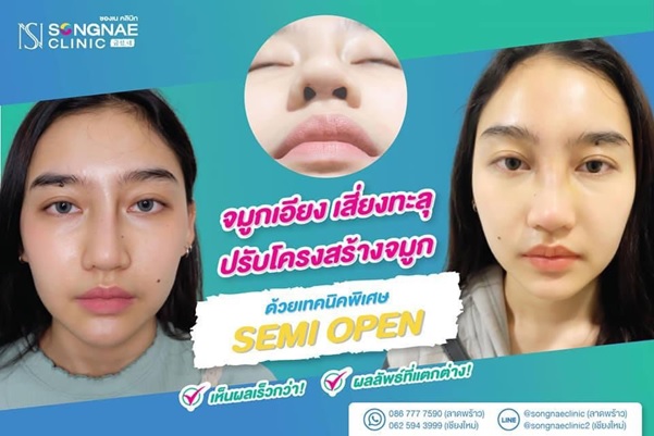 เสริมจมูก เซมิโอเพ่น เสริมจมูก เซมิโอเพ่น