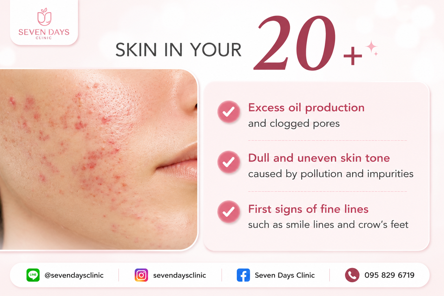 acne program