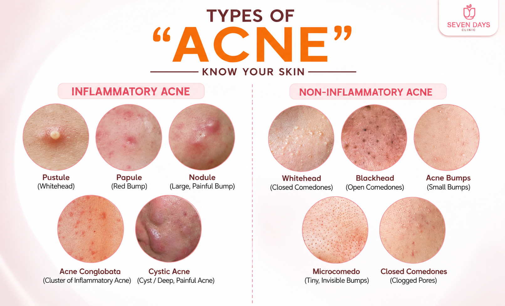 type of acne