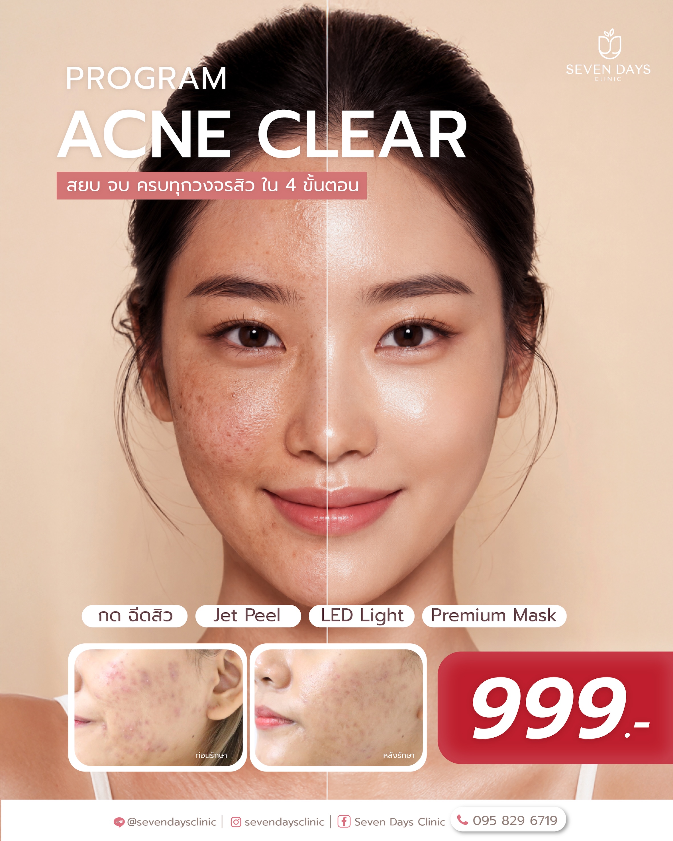 acne program