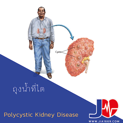 polycystic kidney disease 