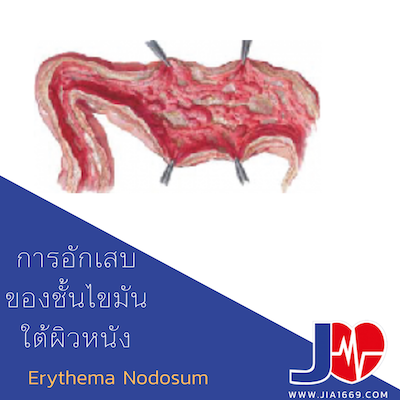 การอักเสบของชั้นไขมันใต้ผิวหนัง Erythema Nodosum