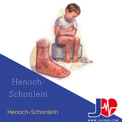 Henoch -schonlein 