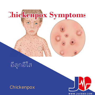 Chickenpox อีสุกอีใส 