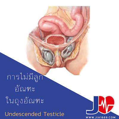 UNDESCENDED TESTICLE