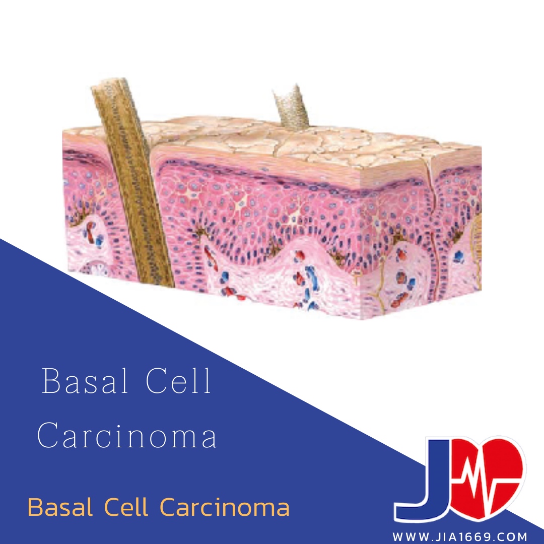 basal cell carcinoma มะเร็งเซลล์ต้นกำเนิด