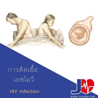 HIV infection