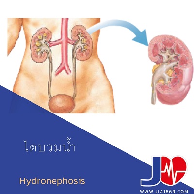 ไตบวมน้ำ hydronephrosis