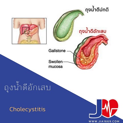 Cholecystitis 