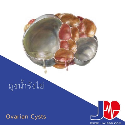 ถุงน้ำรังไข่ Ovarian Cysts