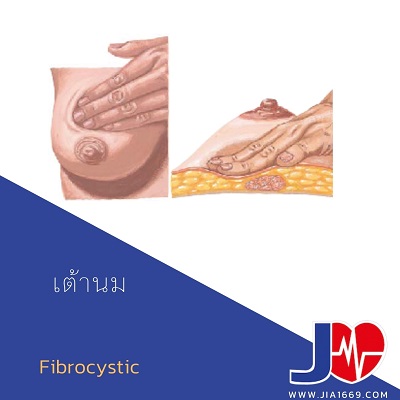 โรคเต้านม fibrocystic