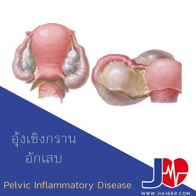 Pelvic Inﬂammatory Disease