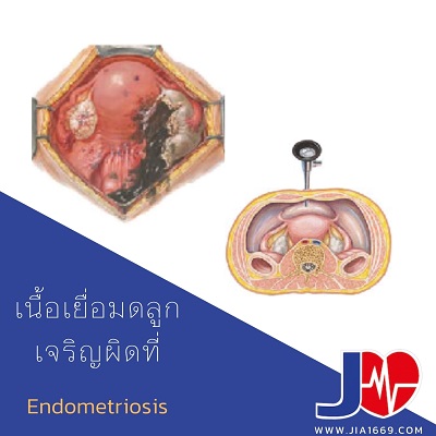 เนื้อเยื่อมดลูกเจริญผิดที่ Endometriosis