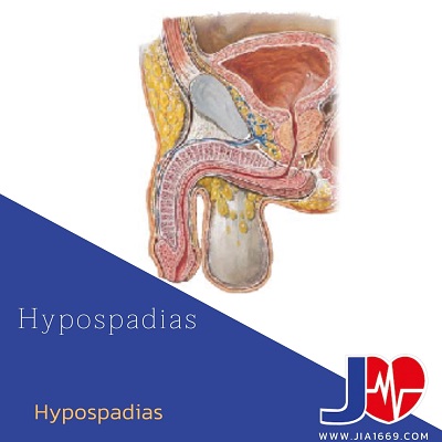 HYPOSPADIAS รูปิดท่อปัสสาวะต่ำกว่าปกติ