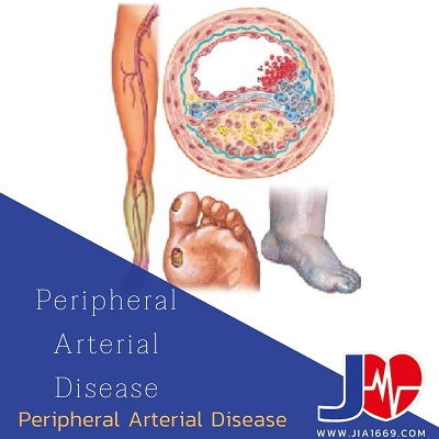 peripheral arterial disease โรคหลอดเลือดแดงส่วนปลาย