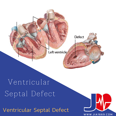 Ventricular Septal Defect (VSDs)