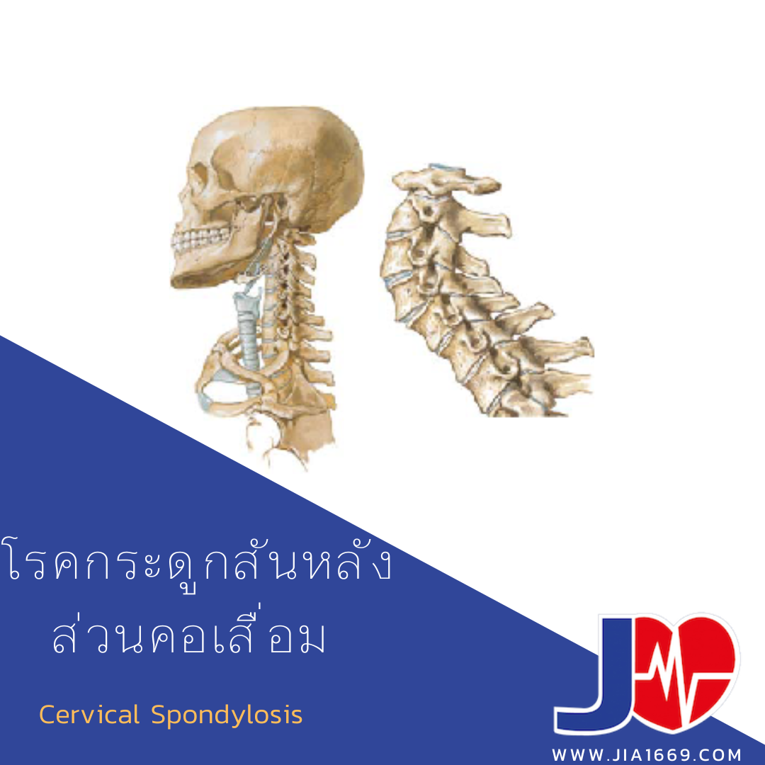  Cervical Spondylosis