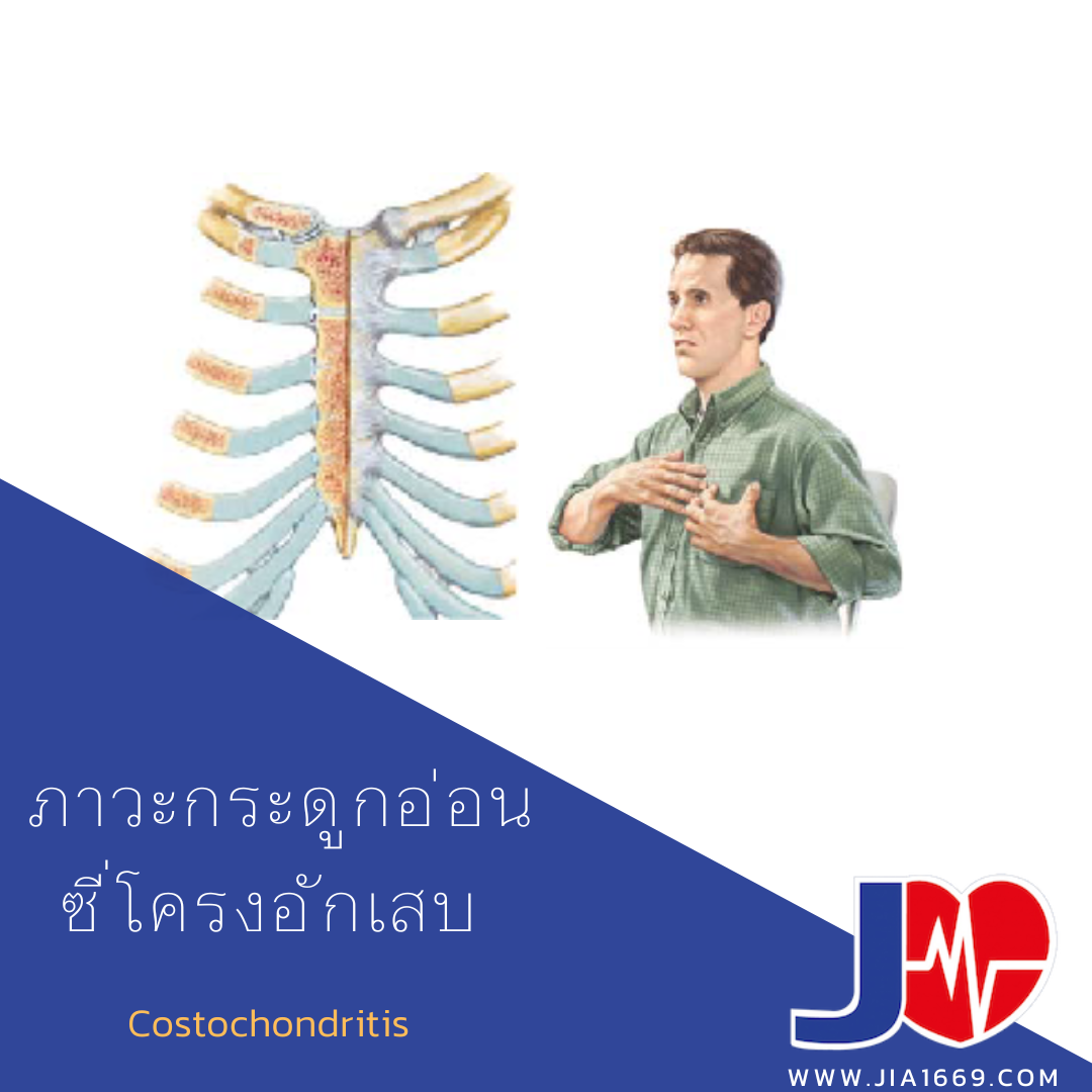 Costochondritis 
