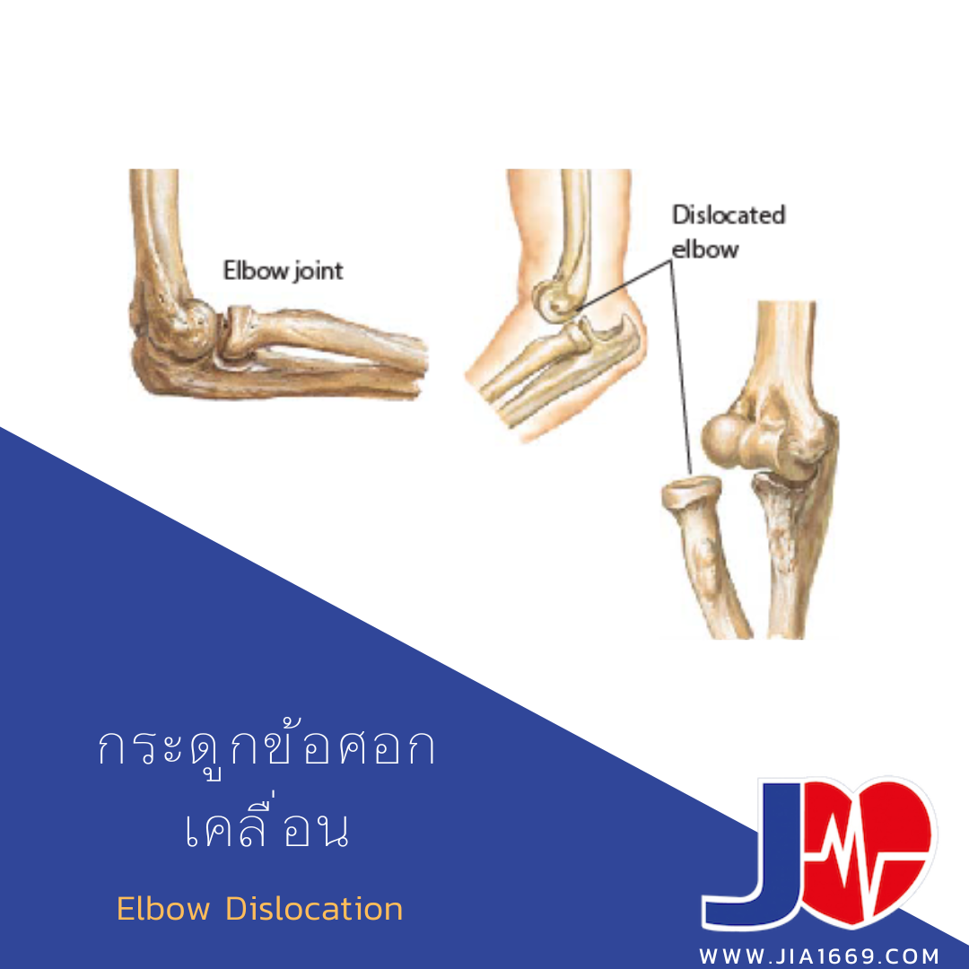 Elbow Dislocation 