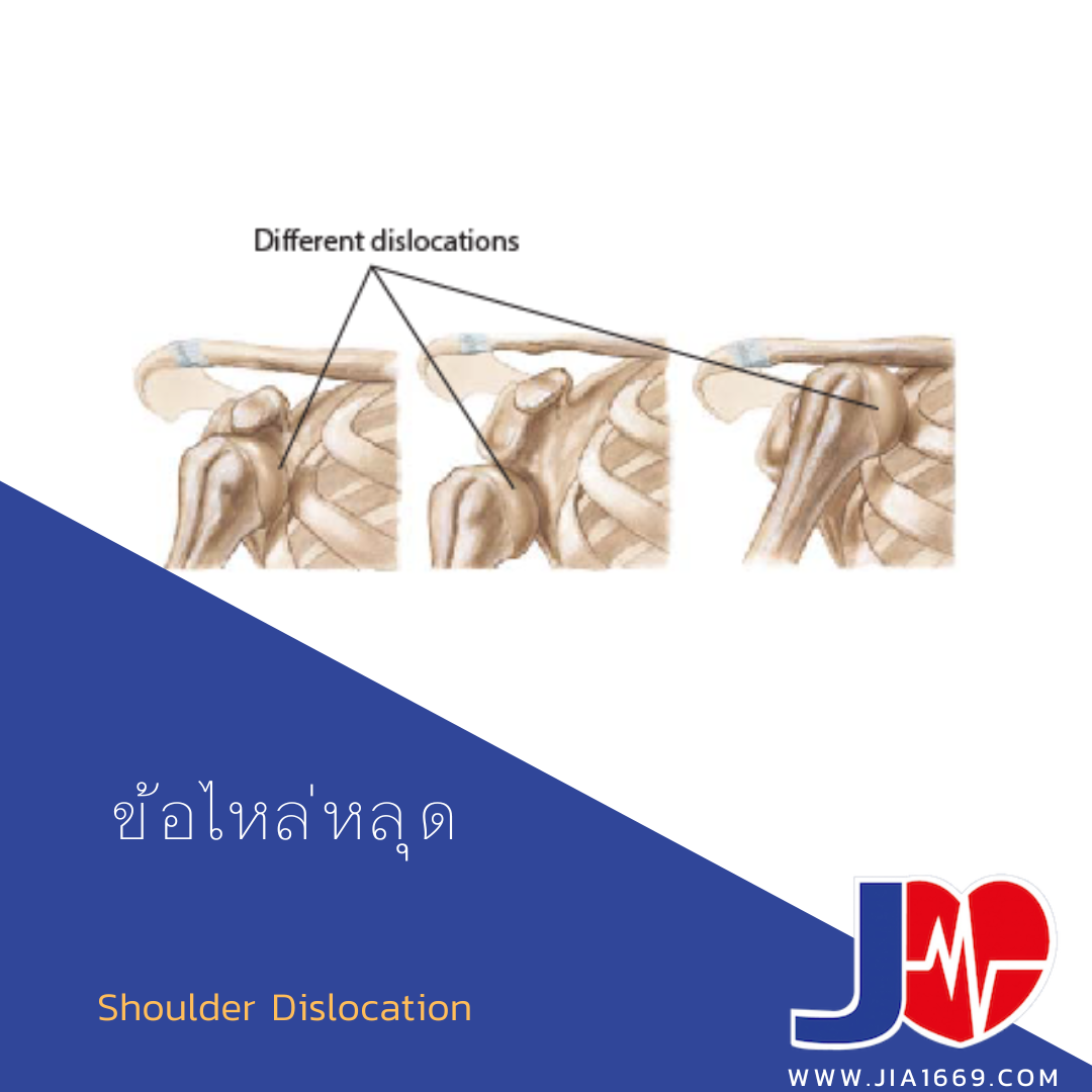 Shoulder Dislocation 